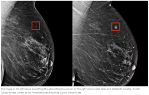 https://www.unilad.com/technology/ai-detected-breast-cancer-years-before-developed-737052-20230325 